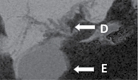 Рис. 5. МСКТ с внутривенным контрастированием (D – внутрипеченочная билиарная гипертензия; E – увеличение размеров желчного пузыря)