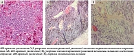 Рис. 2. Больной М. Морфологическая картина слабопигментированной увеальной меланомы эпителиоидноклеточного строения