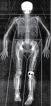 Рис. 3. Симметрично выделенные субрегионы бедренных костей и костей голеней у пациента с эндопротезом левого коленного сустава (программа Whole body  («Все тело»))