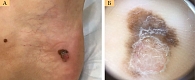 Рис. 3. Больная Р., 57 лет: беспигментная меланома на фоне невуса кожи стопы  (клиническое (А) и дерматоскопическое (Б) изображение)