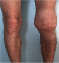 Рис. 1. Больной П., выраженная дефигурация левого коленного сустава