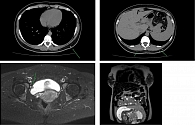 Компьютерная томограмма органов грудной клетки и магнитно-резонансная томограмма брюшной полости и малого таза пациентки И.