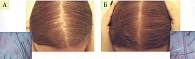 Рис. 7. Пациентка К. с андрогенетической алопецией до (А) и после применения аутологичной стромально-васкулярной активации роста волос в сочетании с заместительной терапией продуктом Нуркрин (Б)