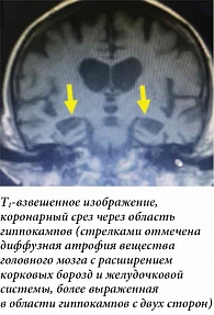 Рис. 3. Магнитно-резонансная томограмма головного мозга: