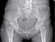 Рис. 7. Рентгенограмма таза при сакроилиите первой стадии