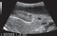 Рис. 2. Врожденный компенсированный пилоростеноз у мальчика 3 месяцев. Продольное сканирование антрально-пилорического отдела. Отдел удлинен до 25 мм, толщина мышечного слоя составляет 4,6 мм. Пассаж по широкому просвету канала свободен. Только через 2 не