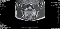 Рис. 3. Магнитно-резонансная томограмма КПС пациента К. в режиме Т1 через полгода (признаки жировой дегенерации не выявляются, однако имеются небольшие единичные узуры (указаны стрелками))