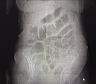 Рис. 1. Обзорная рентгенография брюшной полости стоя в прямой проекции в первые сутки. Наблюдается выраженный пневматоз кишечника