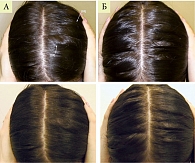 Рис. 9. Эффект комплексной терапии с применением Нуркрина у пациентки 25 лет с хроническим телогеновым выпадением волос (А – до лечения, Б – после четырех месяцев лечения)